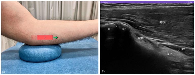 Tendon distal biceps 4 2 Tempo Formacion Ecografia.jpg